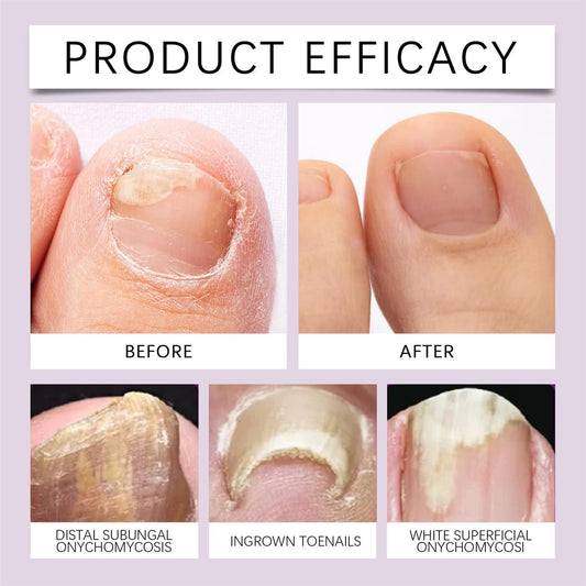 Fungi Free Bee Venom Nail Repair Serum – 15ml | Natural Nail Fungus Treatment & Strengthener