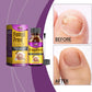Fungi Free Bee Venom Nail Repair Serum – 15ml | Natural Nail Fungus Treatment & Strengthener